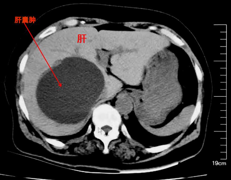 肠子摸上去有硬块就一定是肿瘤吗,乳腺有个鸡蛋大的硬块会是肿瘤吗