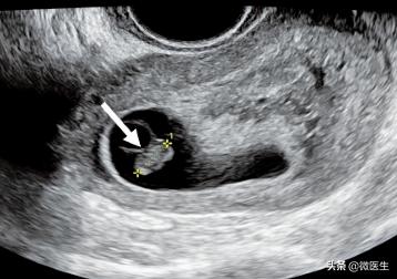 一分钟看懂孕期b超图,孕期32周照b超宝宝头大怎么办