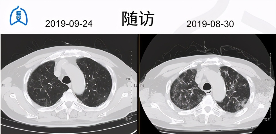 阵发性房颤和用药有关系吗,房颤药物控制好了还会复发吗