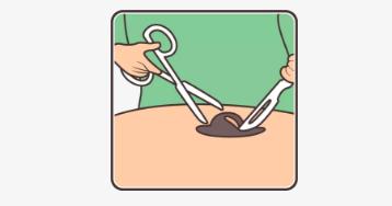 「健康」人无大“痣”,未必不是好事