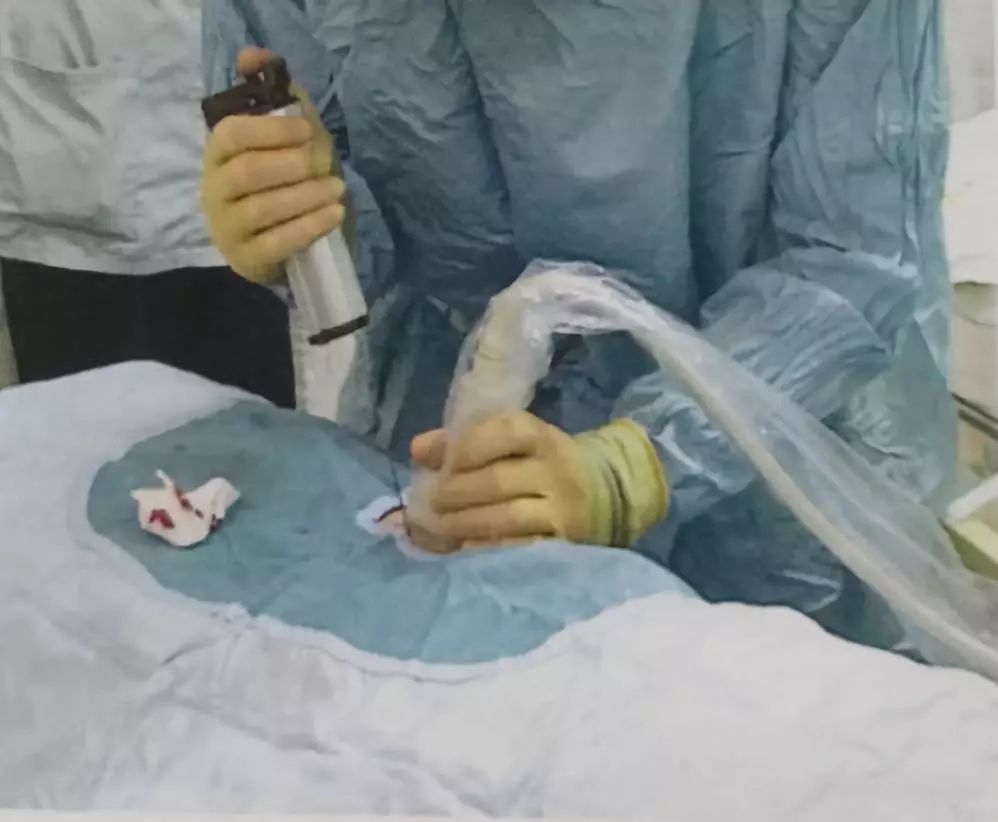 肾穿刺活检术住院多少天费用多少,肾穿刺活检术后护理