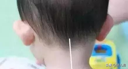 孩子咳嗽不好推拿手法,小儿推拿后为什么咳嗽反而加重了