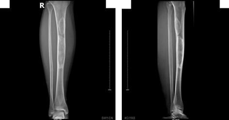 骨纤维结构不良是骨肿瘤吗？孩子高发，怎么才能发现呢？