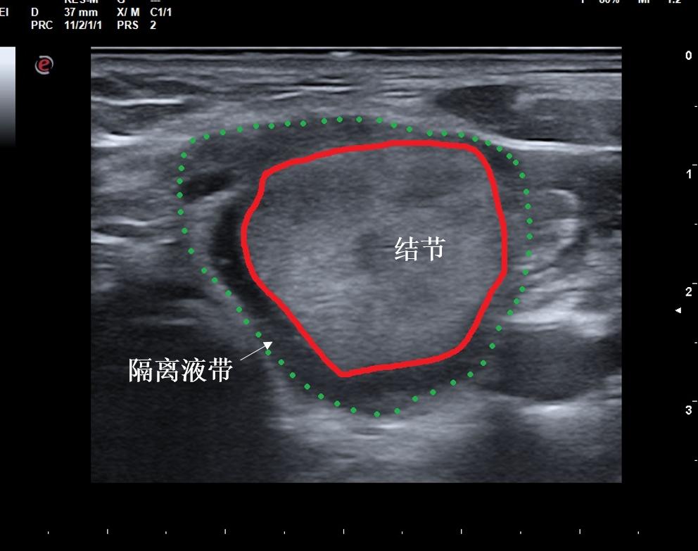 哈尔滨微创消融甲状腺结节哪家好,甲状腺结节微创消融术的过程