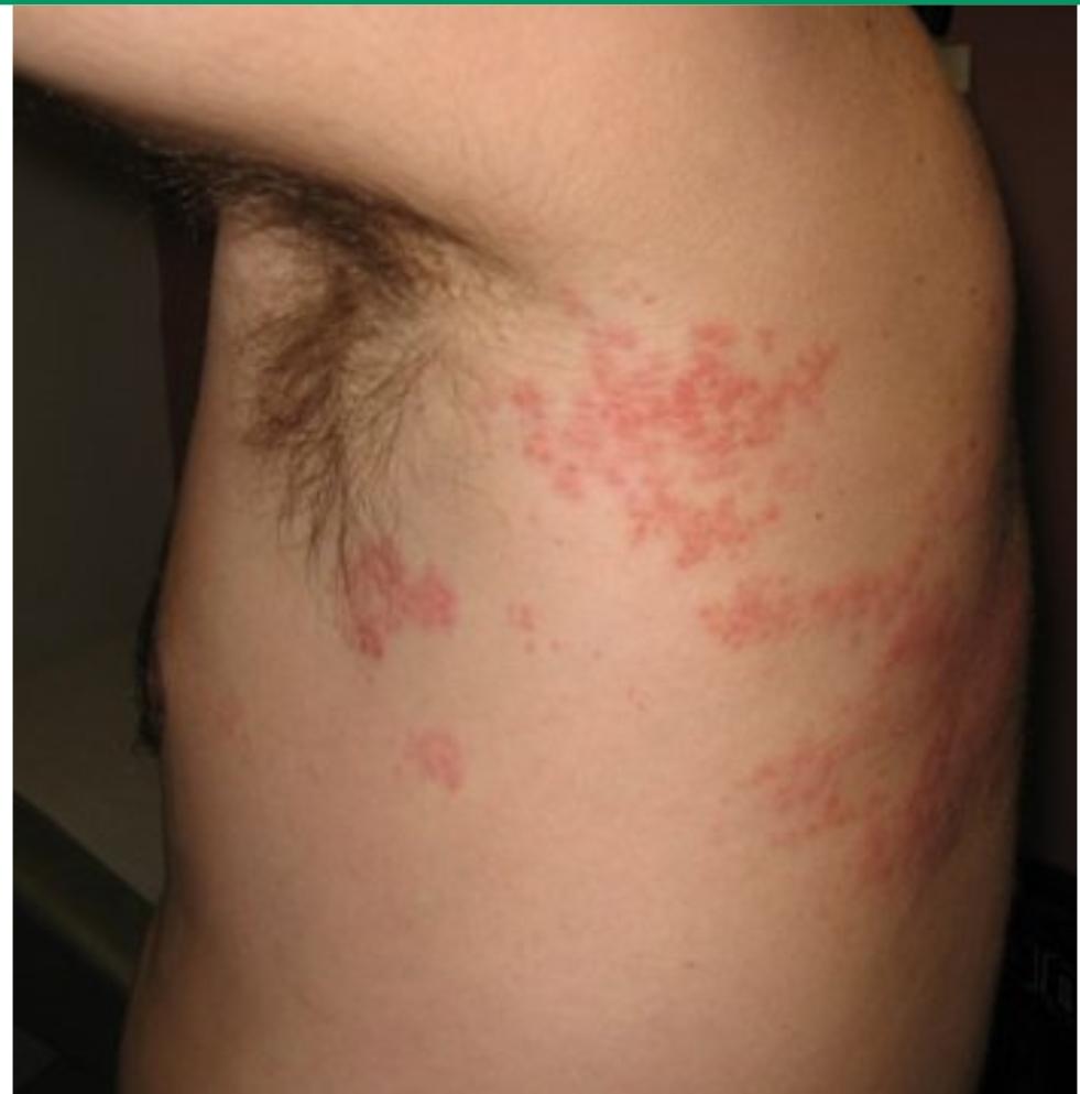 民间所谓的生蛇是什么病,民间说生蛇什么意思