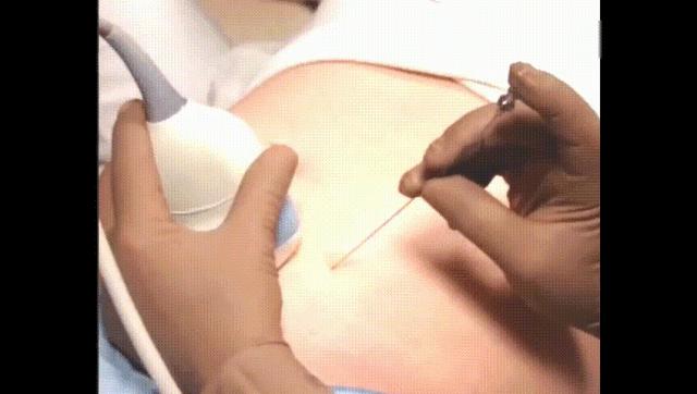 产检唐筛高风险是怎么回事,孕妇产检做几次唐筛