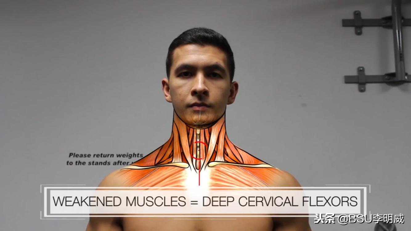 躺床头前倾矫正,怎么纠正头前倾