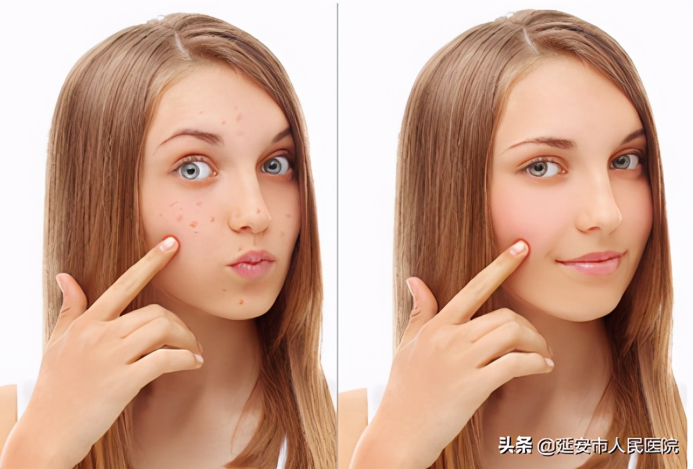 痒到怀疑人生,痒到钻心的湿疹是哪一种