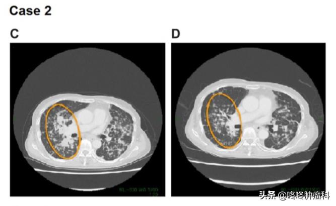 治癌症的靶向药有副作用吗,抗癌靶向药肺癌