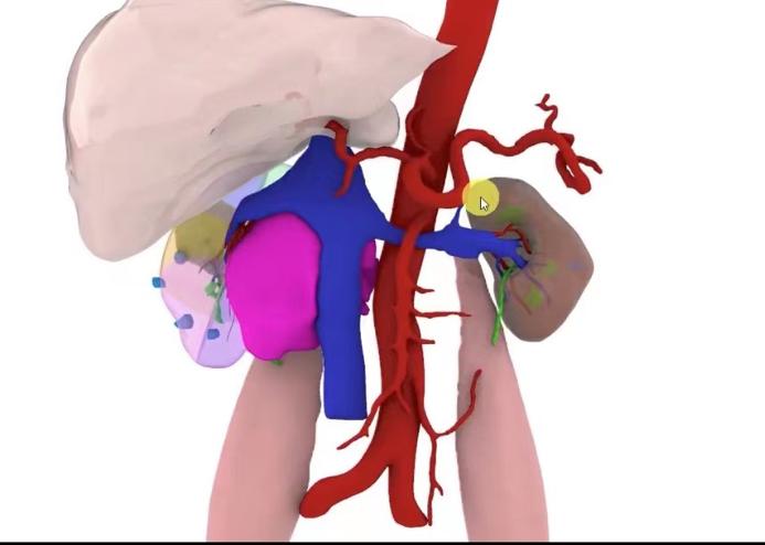 3d动画演示腹腔镜辅助手术,3d动画演示腹腔镜切除回盲部肿瘤