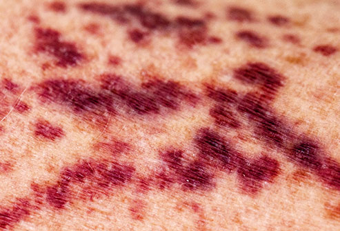 皮肤青紫淤痕怎么办,身上经常出现青紫瘀痕后果严重吗