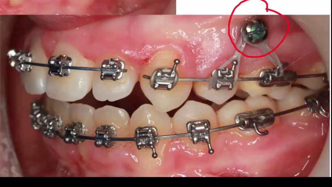 矫正牙齿在牙龈打钉子多久能取,整牙一定要在牙龈里打钉子吗
