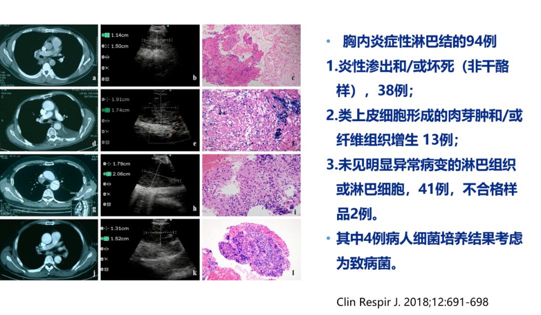 全球对肺癌治疗的最有效最新技术,肺癌的支气管镜介入治疗