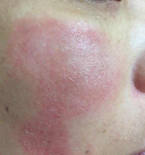 五十岁人脸部过敏是什么原因,脸部过敏1天的最快恢复方法