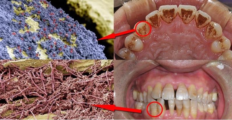 放大两千倍的牙齿表面长什么样？不愧是人体最脏的地方，不堪入目