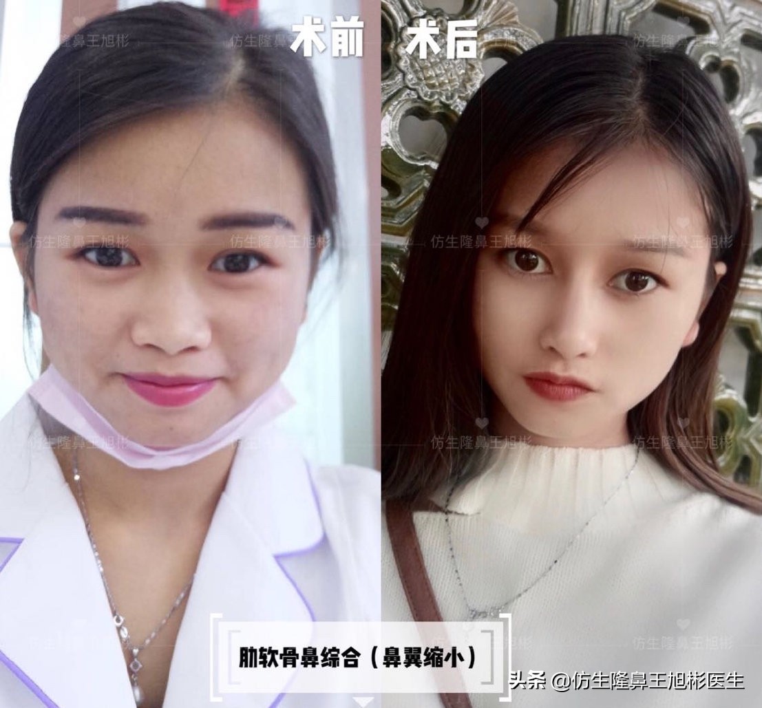 短鼻延长的最佳方法,短鼻修复前后对比案例