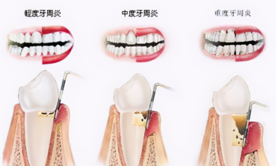 上海牙齿松动怎么修复,牙齿松动修复固齿医院