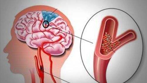下肢血管狭窄能疏通吗,冠心病血管狭窄可以疏通吗