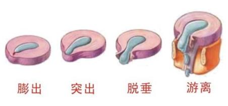膨出型突出型脱出型游离型分类,腰椎间盘膨出和腰间盘突出的区别