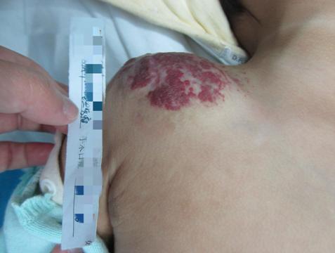 女婴右肩斑块连结混合型血管瘤生长迅速