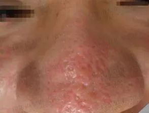 鼻头毛孔粗大如何改善缩小毛孔,皮肤毛孔粗大出汗可以缩小毛孔吗