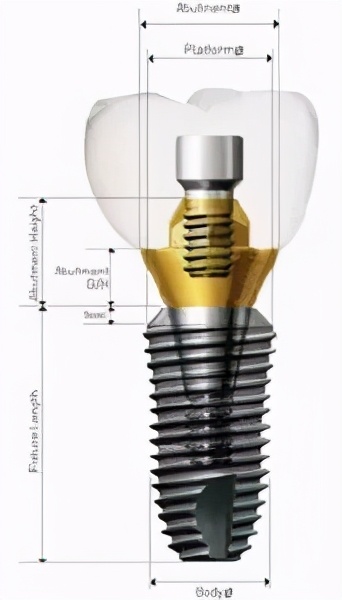 雅悦齿科种牙,雅悦齿科种植牙价格