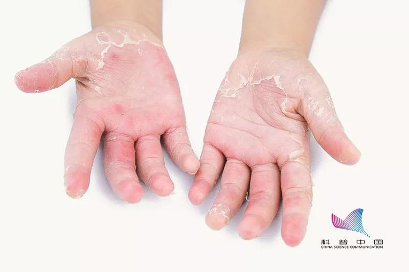 为什么一到夏天手上就长水泡很痒,一到夏天就痒长水泡
