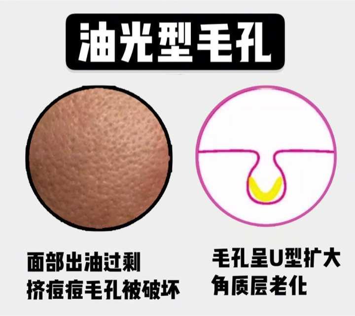 夏季毛孔堵塞怎么办,夏季皮肤毛孔粗大油腻怎么办