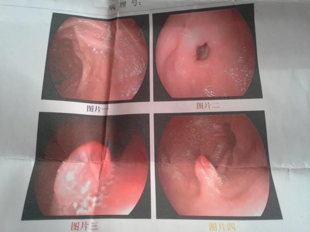 胃息肉一定要切除吗有危险吗,为什么胃息肉不建议切除