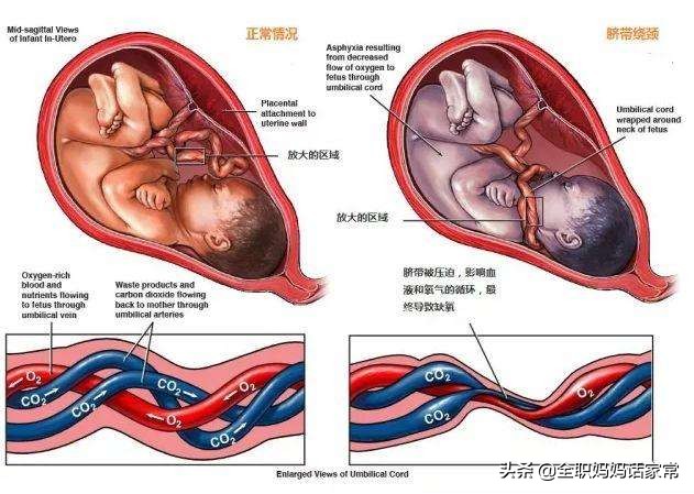 孕晚期脐带绕颈一周并有u型压痕,孕晚期脐带绕颈2周小肚有下坠感