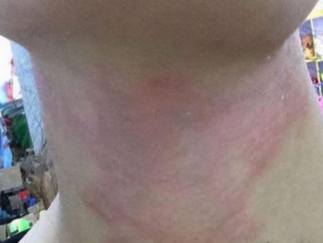 被隐翅虫咬伤有多可怕,被隐翅虫咬后症状图片及治疗方法