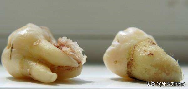 上面智齿长歪向脸颊好不好拔,智齿长歪了拔了多少钱