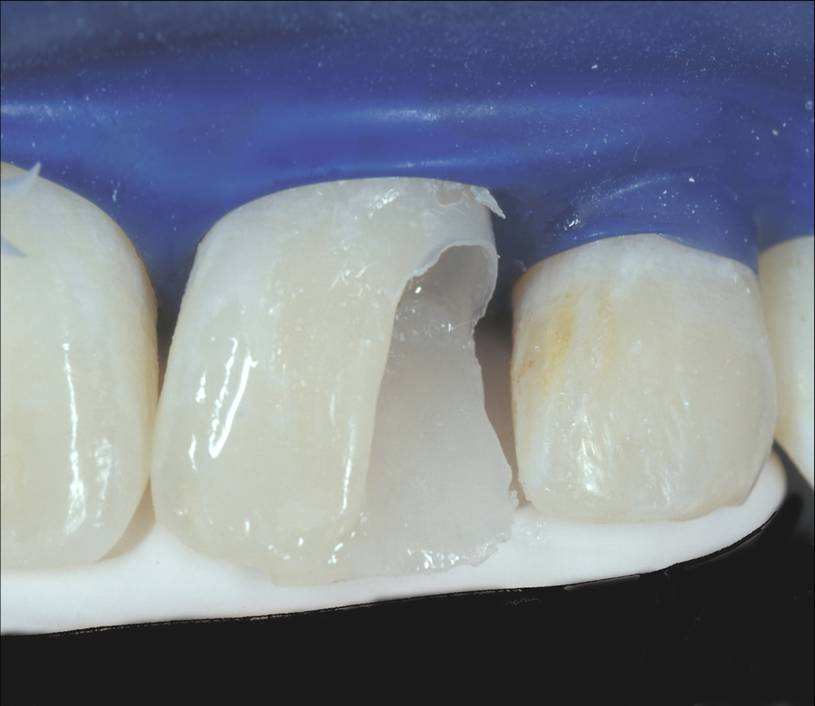 我的烤瓷牙掉了,烤瓷牙崩瓷了怎么办