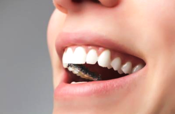 戴牙套戴哪种牙套最好,金属牙套与陶瓷牙套的优缺点