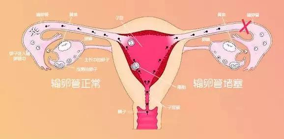 输卵管疏通后还会再次堵吗,输卵管堵了还会来大姨妈吗