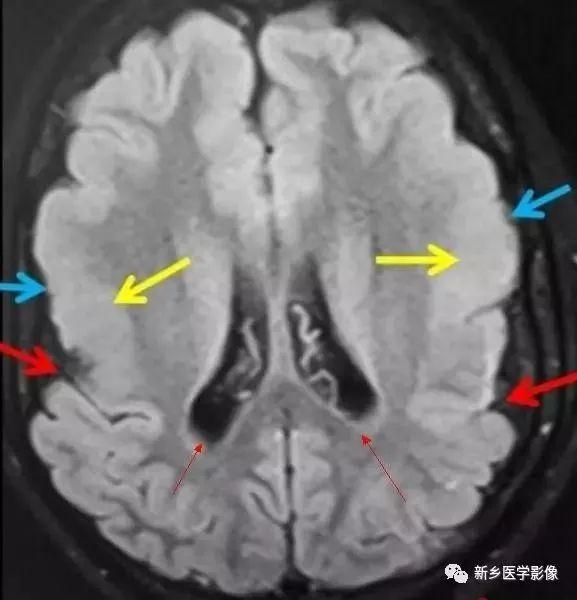 什么引起成人脑室扩大,哪些病可以导致左侧脑室增宽