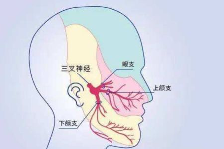 三叉神经痛怎样可以彻底根治,三叉神经痛现在最好的解决办法