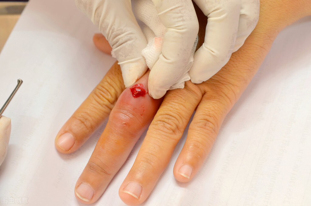 鱼刺扎到手伤口不愈合,鱼刺扎了手指导致截肢
