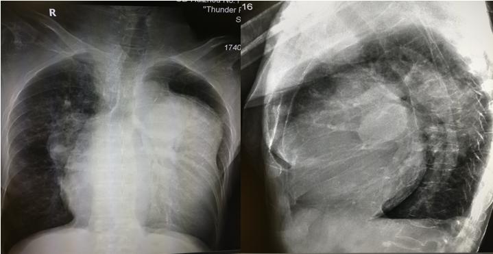 循环系统胸片,体循环和肺循环临床表现