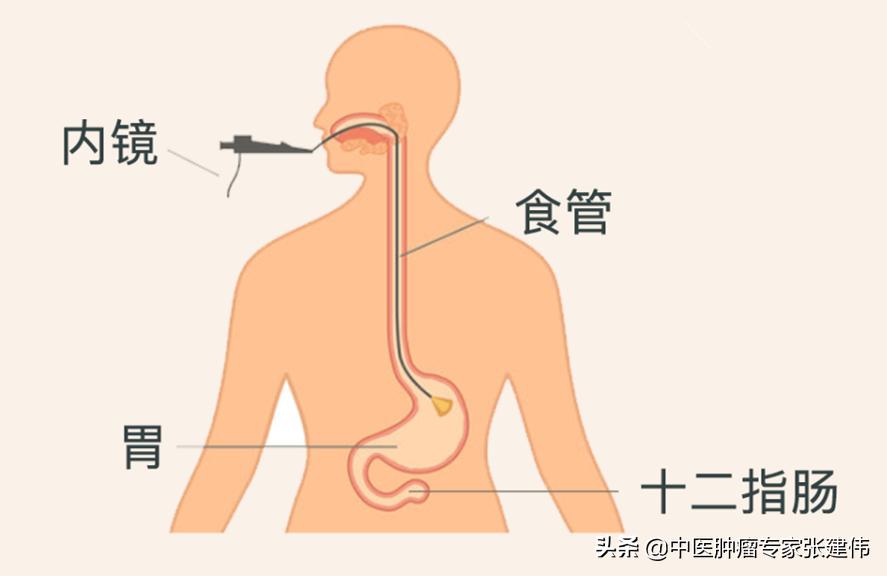 胃镜怎么看整个胃的情况,怎么知道做完胃镜对胃的损伤