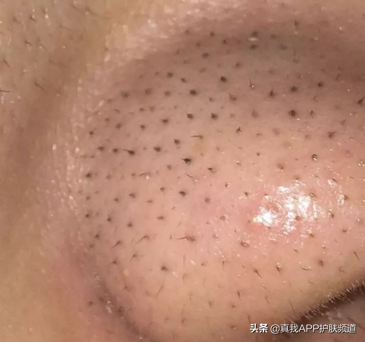 强效去黑头方法,去黑头大科普教你正确去黑头