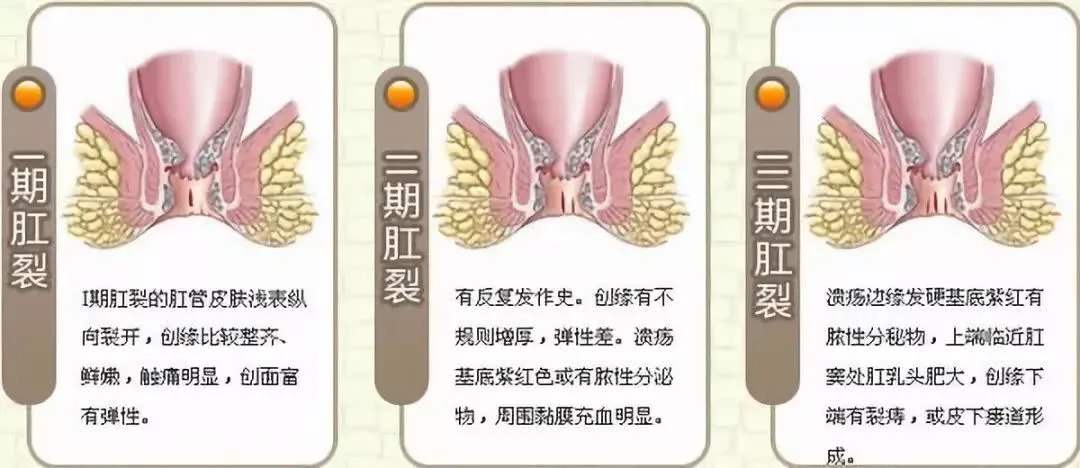 肛裂肛门疼痛应该怎么治疗,肛裂是肛门疾病吗怎么治疗