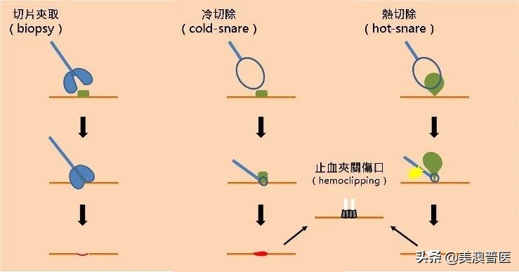 关于肠息肉切除，这些事情你一定要知道！