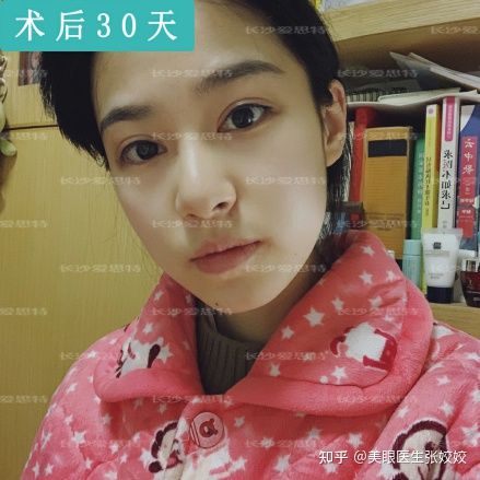 内双的人割双眼皮会更自然吗,怎么把内双变双眼皮的自然方法