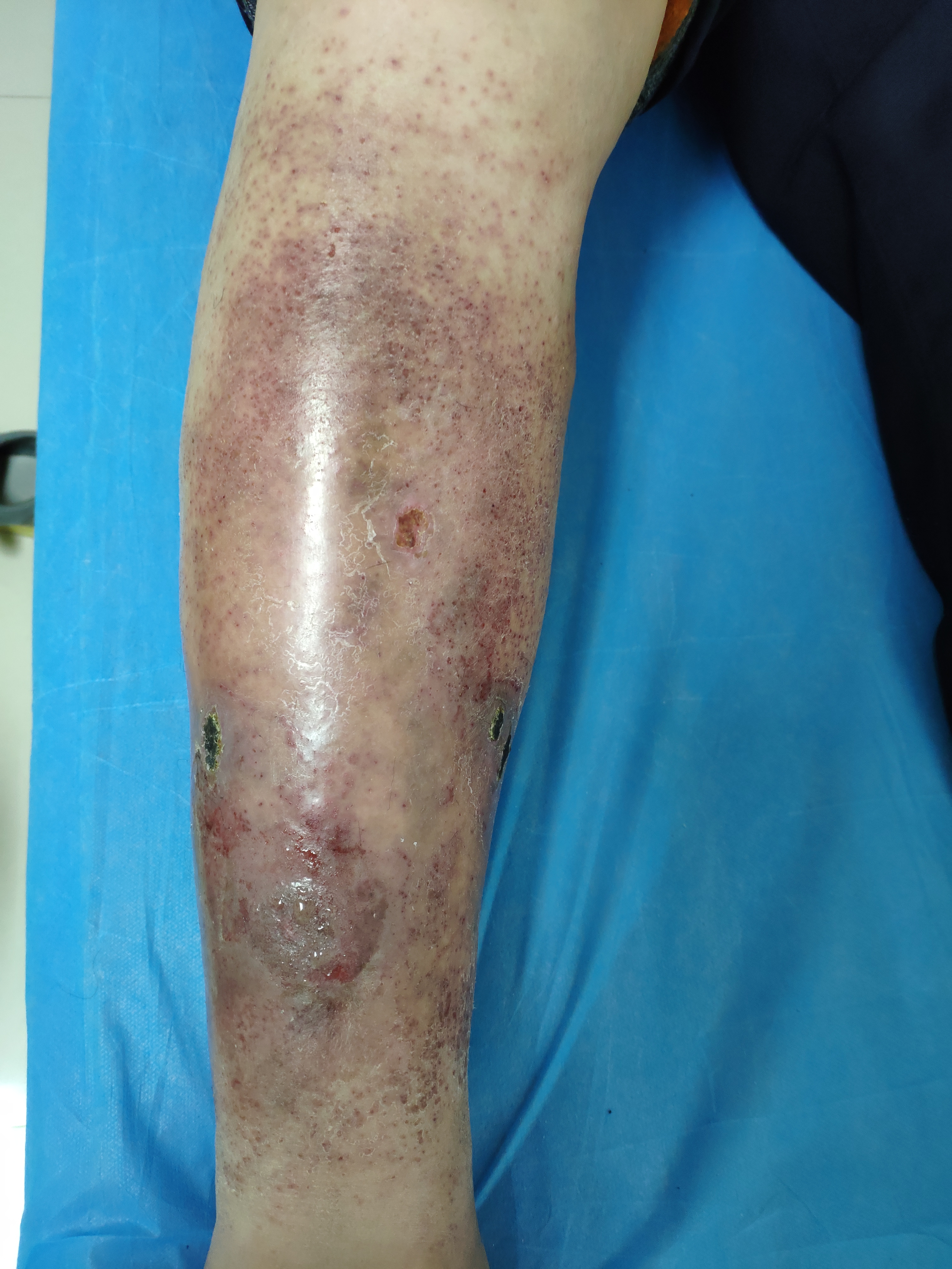 小腿皮肤瘙痒溃烂不愈什么原因,下肢皮肤出现溃烂用什么药