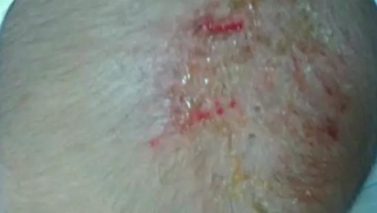 宝宝头垢正确清理方法吴医生,初生婴儿头上脏怎么办