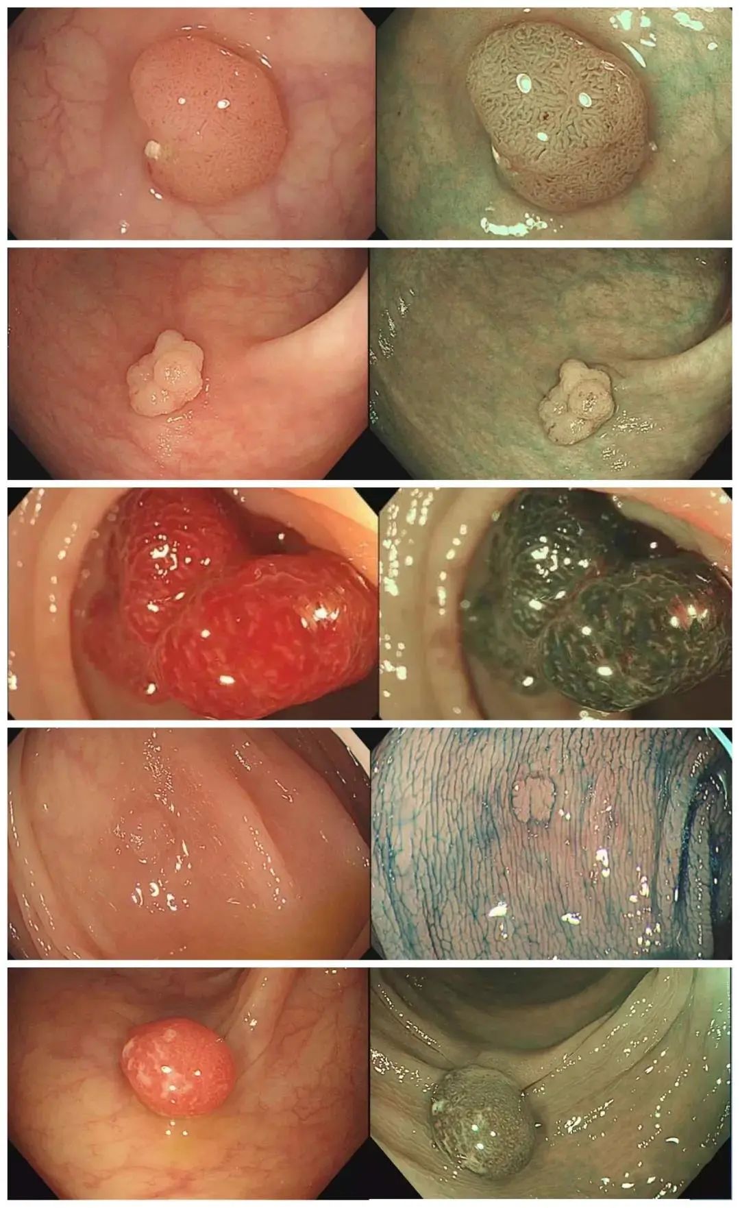 结肠息肉会变癌几率高吗,结肠息肉小的会长大吗