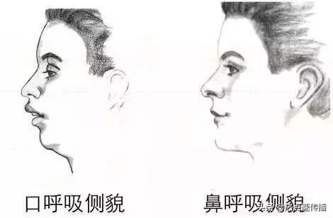 导致下巴歪的原因有哪些,下巴后缩严重的案例