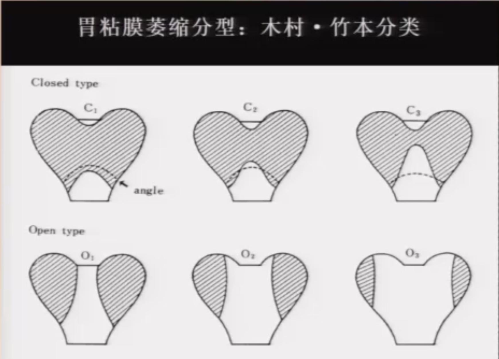 萎缩性胃炎怎样判断严重程度,萎缩性胃炎是怎样诊断的