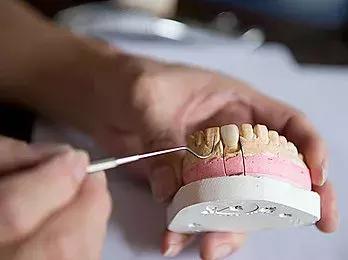 牙齿咬硬物受伤,牙齿受伤吃什么恢复